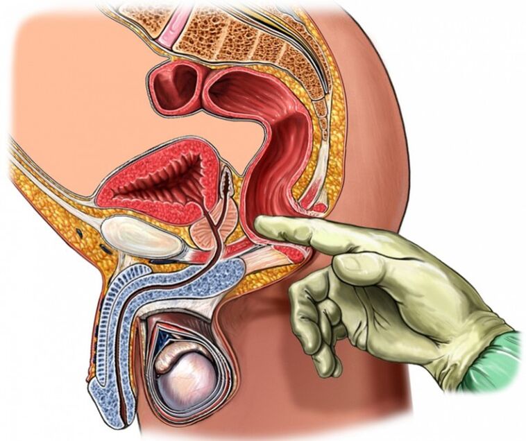 prostaatmassage voor prostatitis