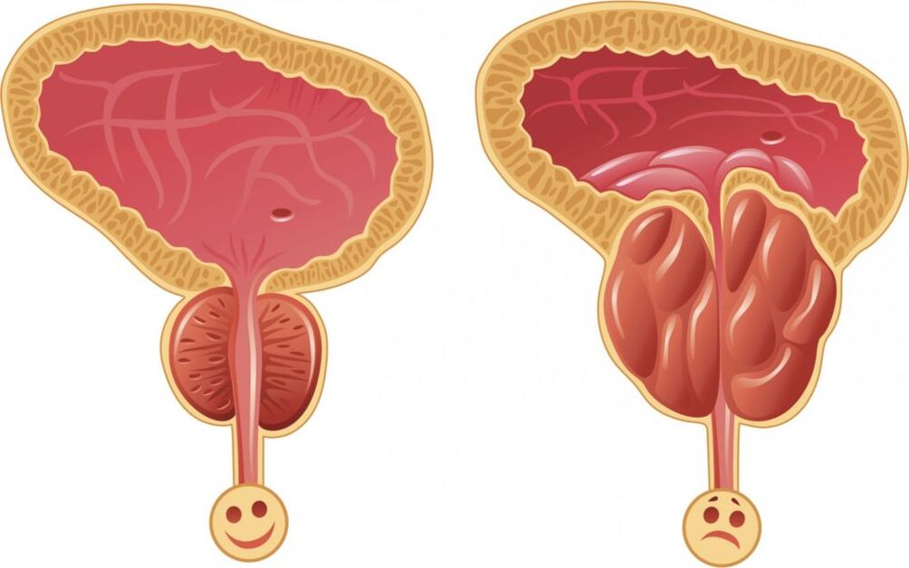 symptomen van prostatitis bij mannen